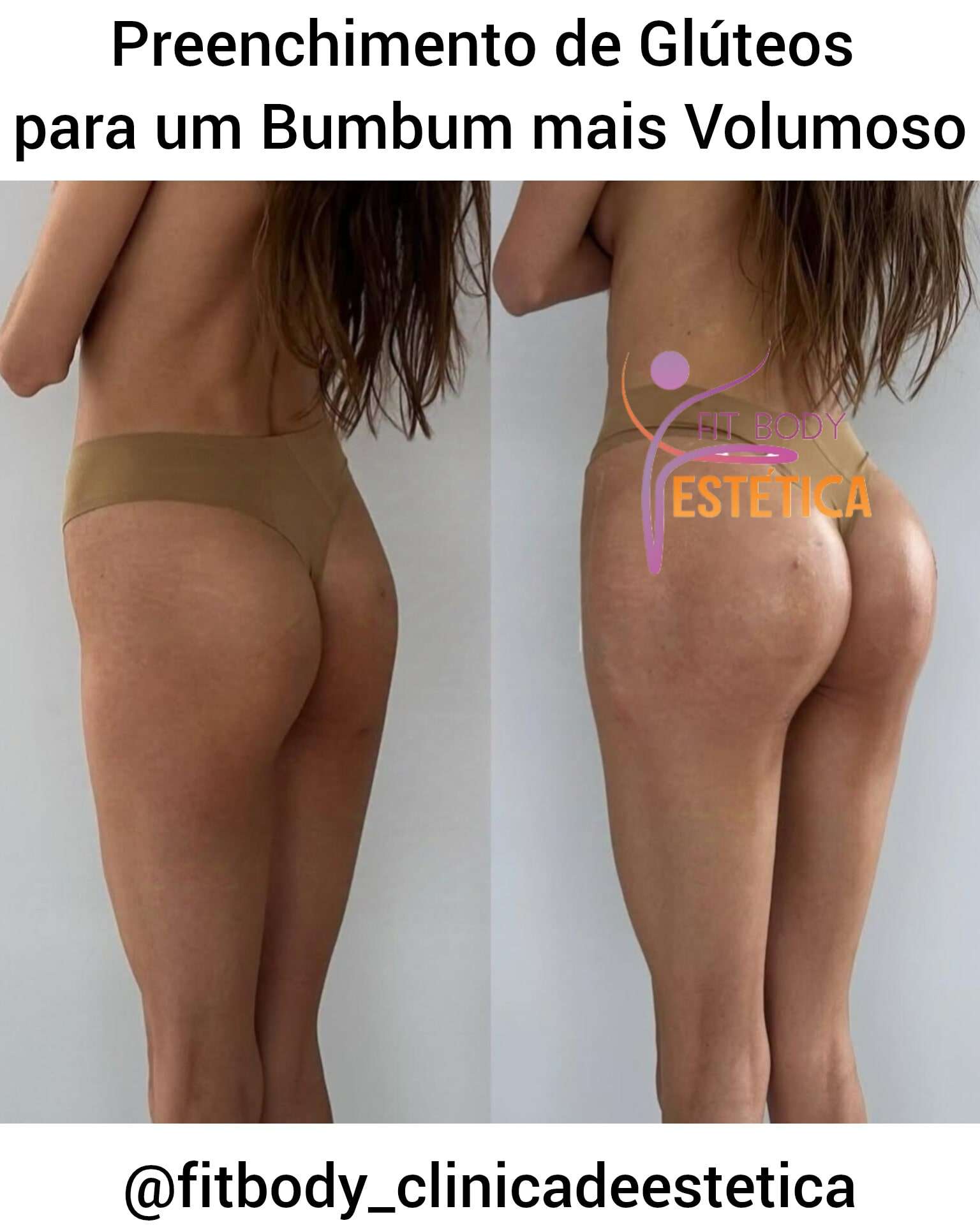 Preenchimento de Glúteos para um Bumbum mais Volumoso