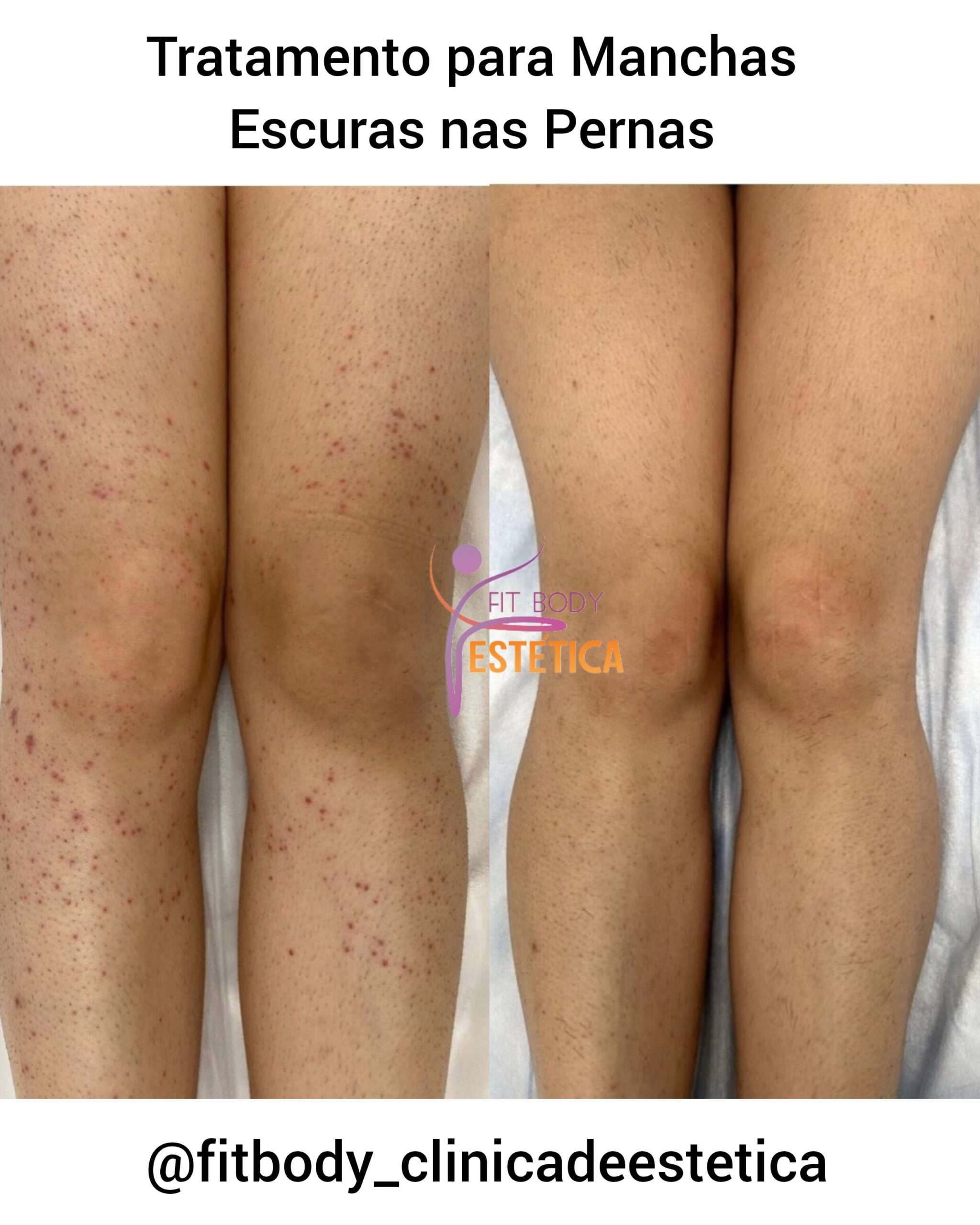 Tratamento para Manchas Escuras nas Pernas