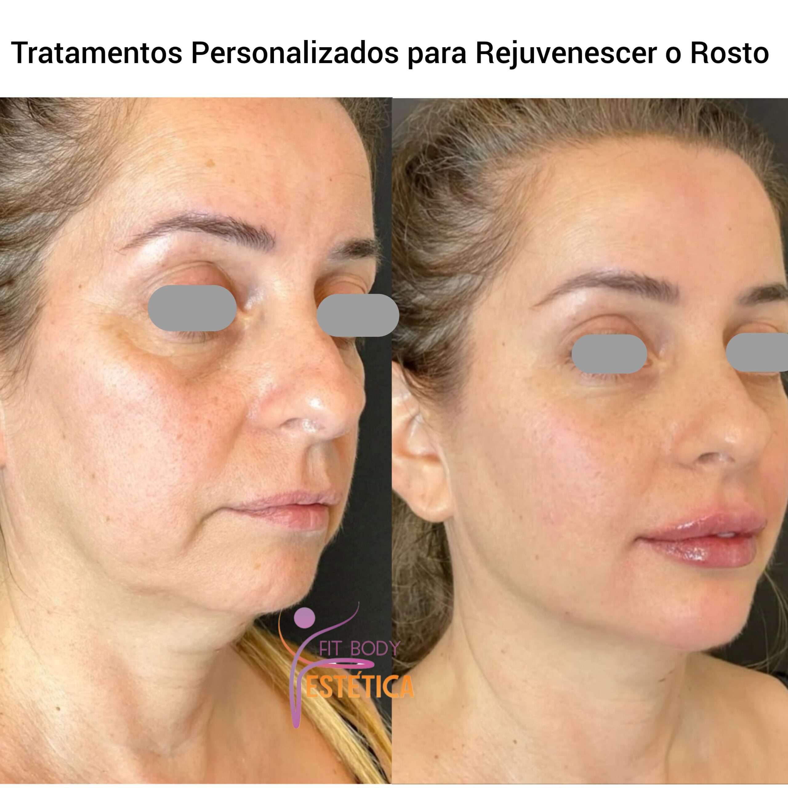 Tratamentos Personalizados para Rejuvenescer o Rosto