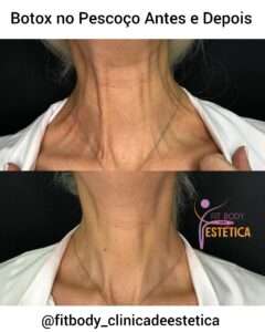 Botox no Pescoço Antes e Depois