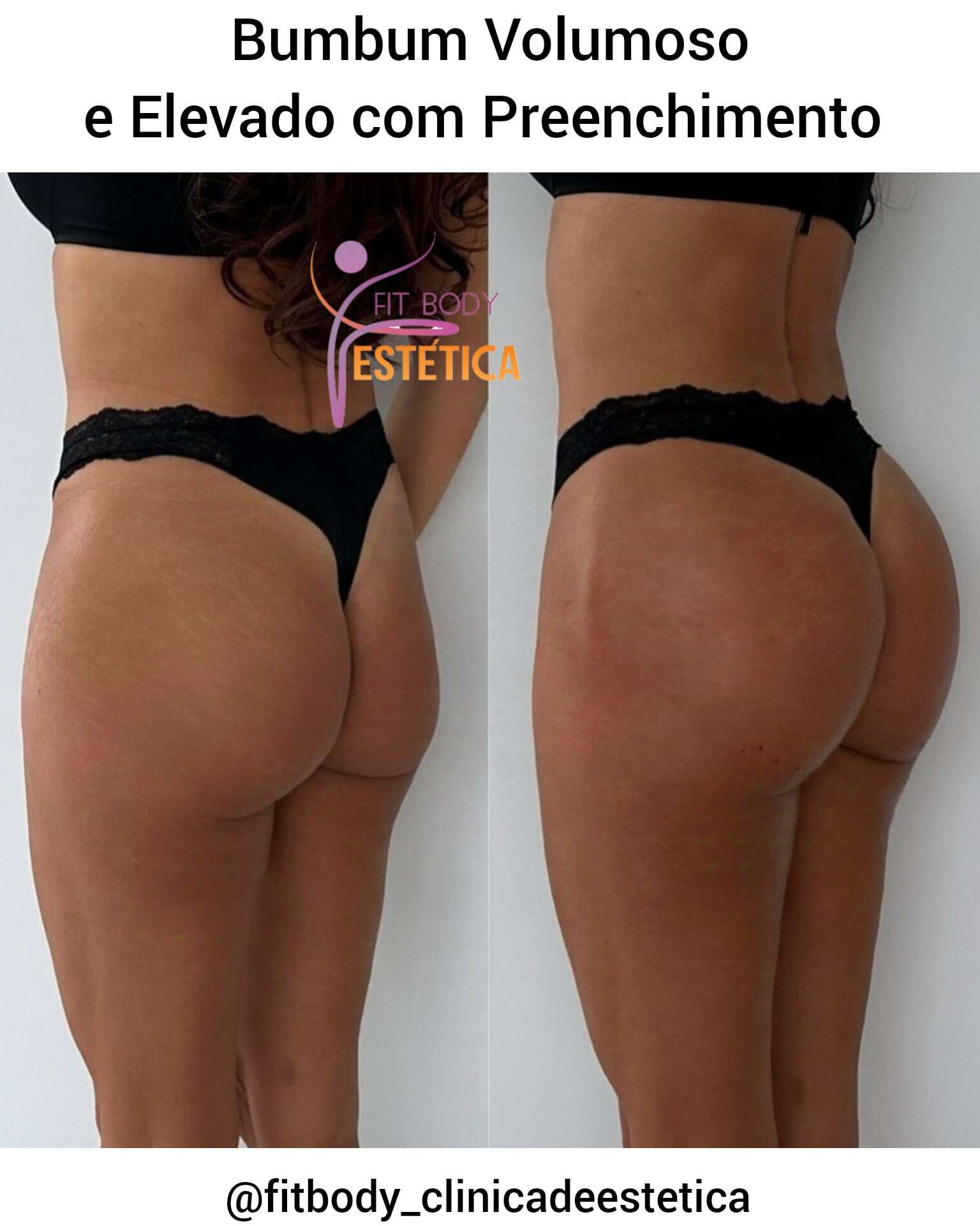 Bumbum Volumoso e Elevado com o Preenchimento