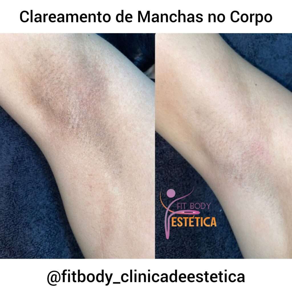 Clareamento de Manchas no Corpo