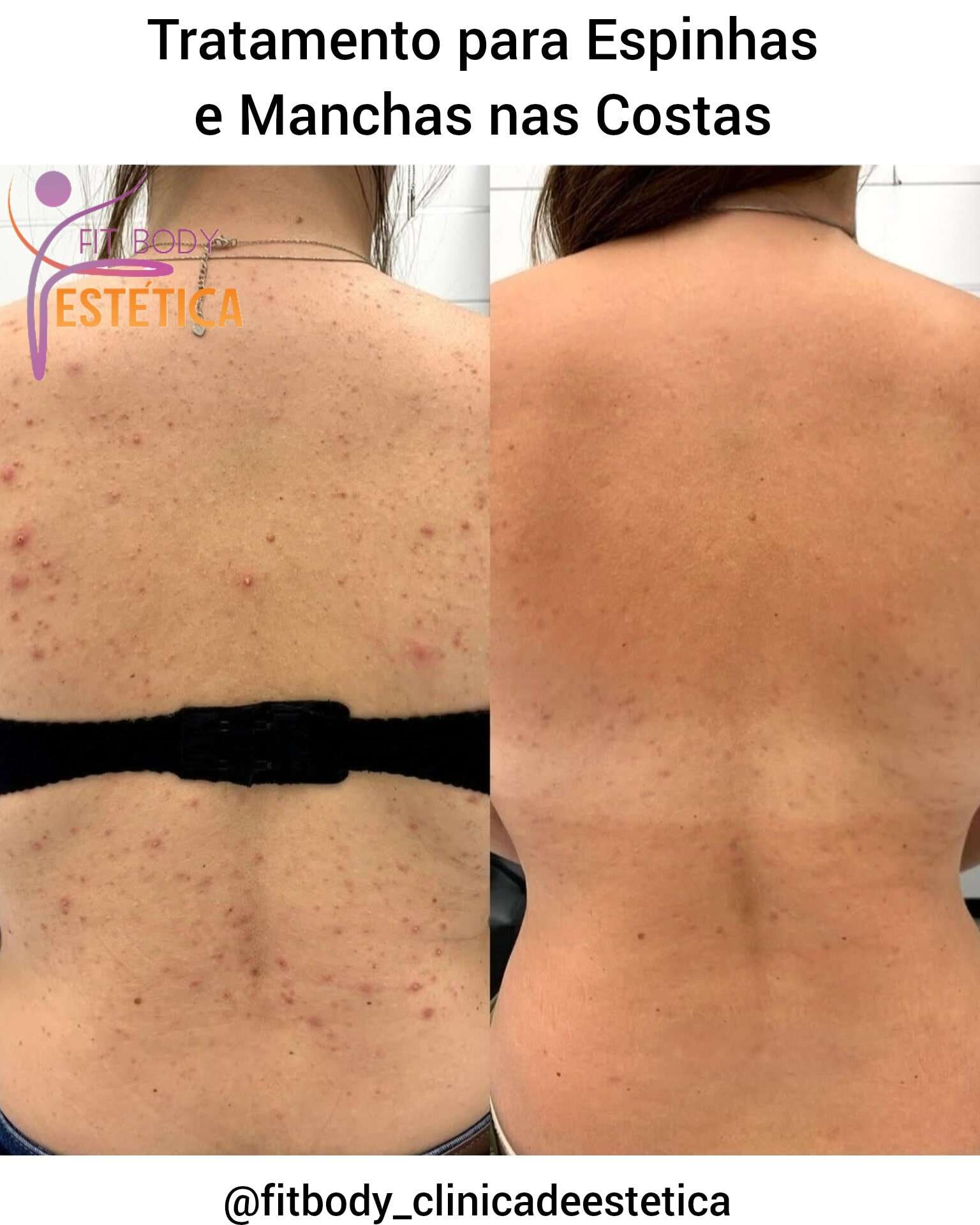 Espinhas e Manchas nas Costas Tratamento