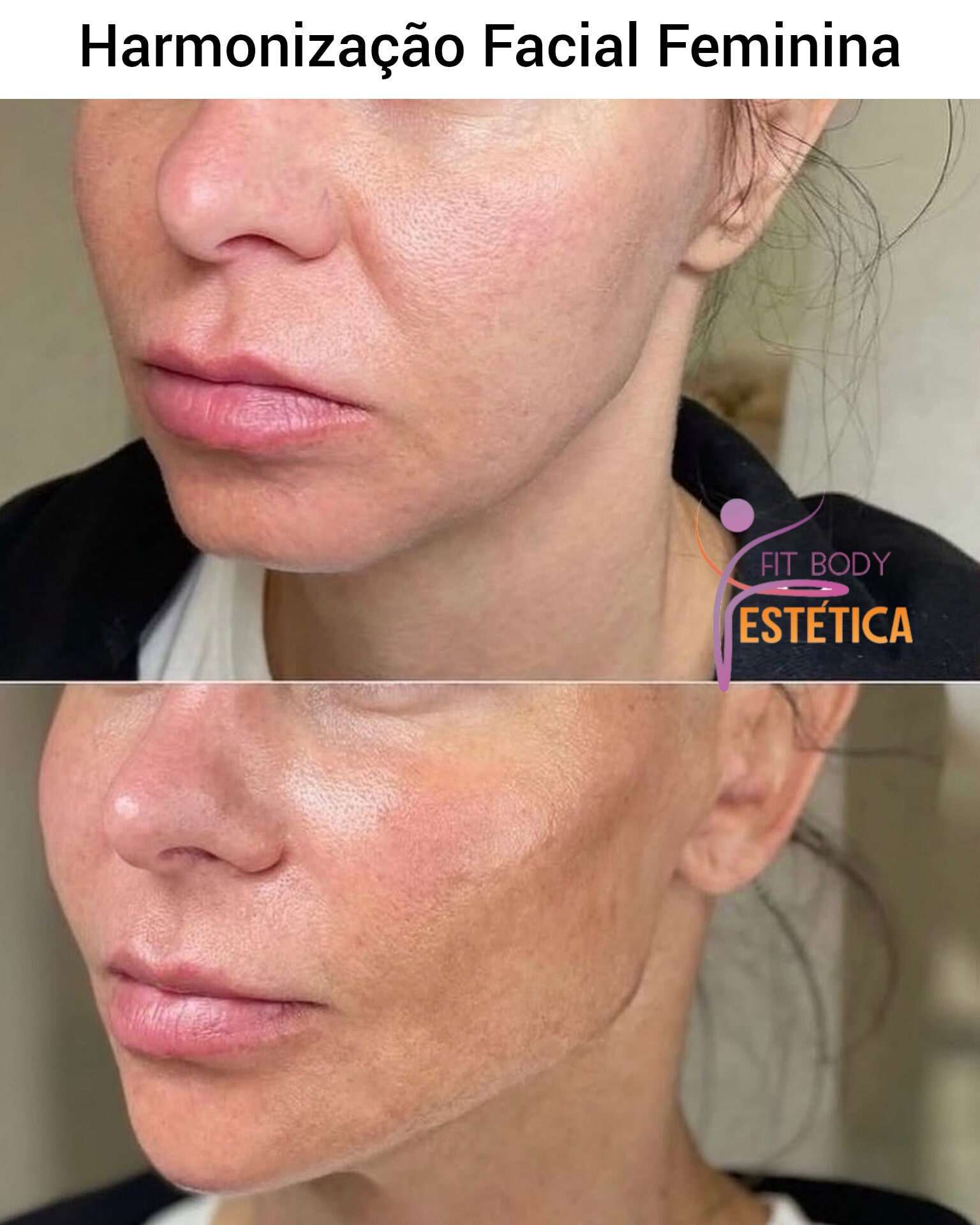 Harmonização Facial Feminina Antes e Depois