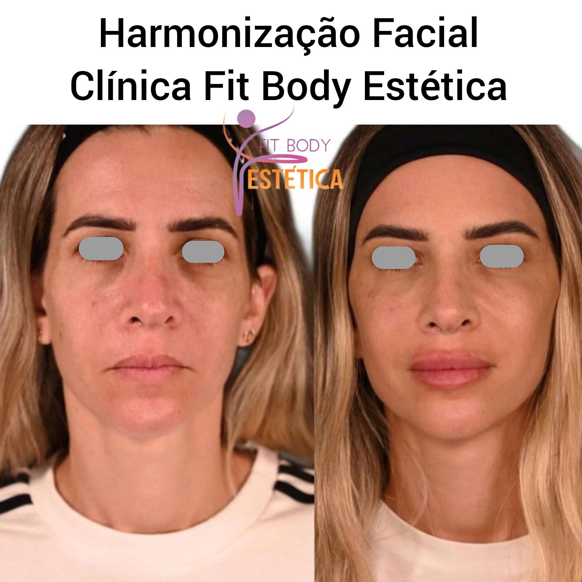 Harmonização Facial para Rejuvenescimento