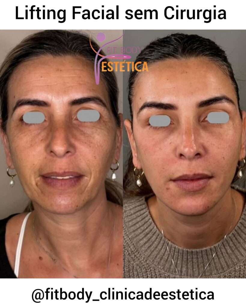 Lifting Facial sem Cirurgia