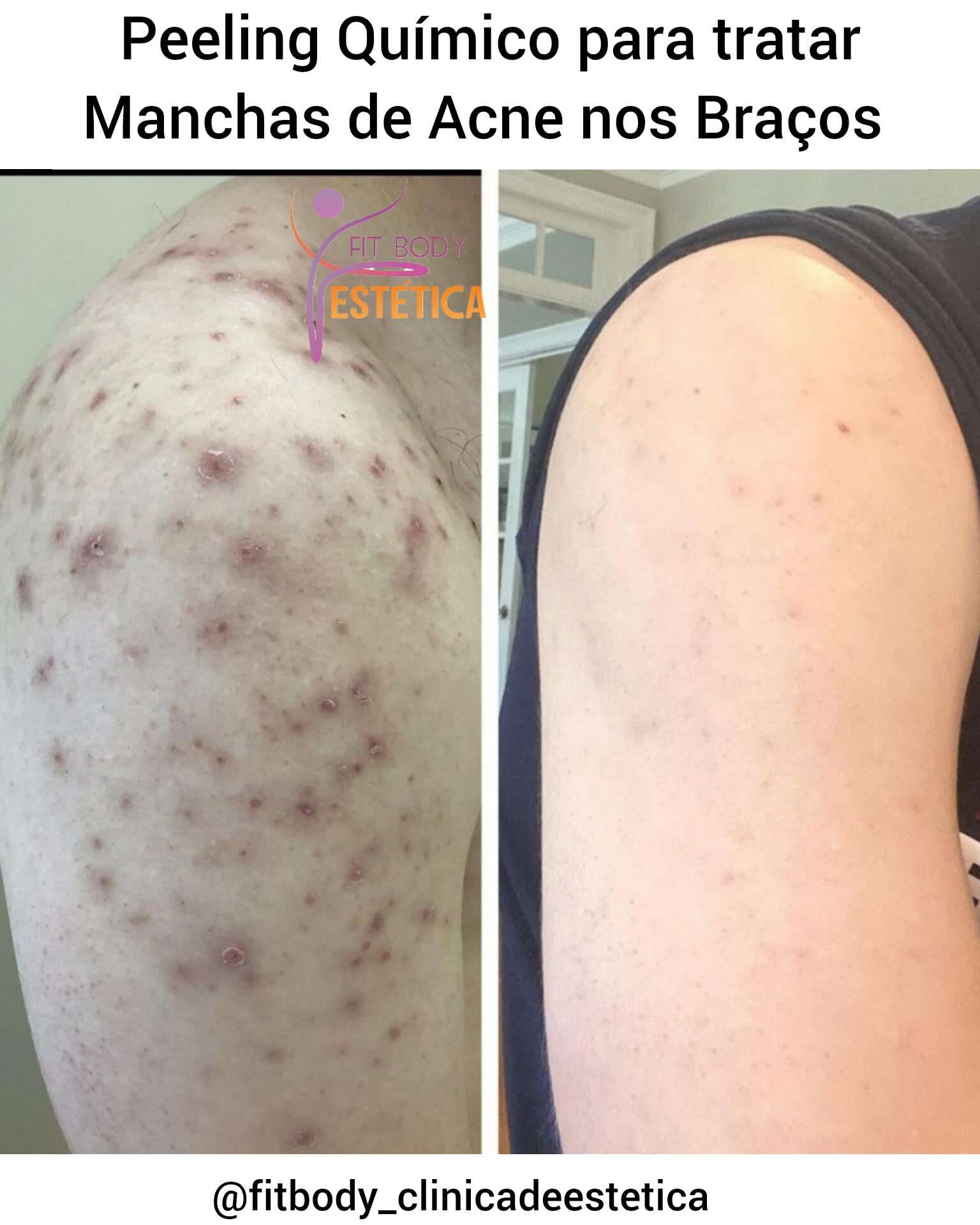 Peeling Químico para tratar Manchas de Acne nos Braços