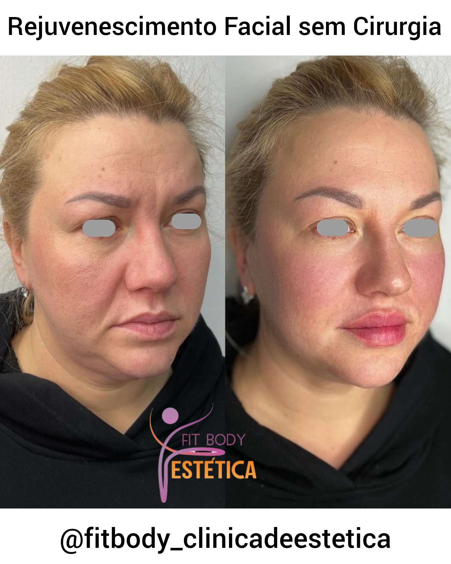 Rejuvenescimento Facial Sem Cirurgia