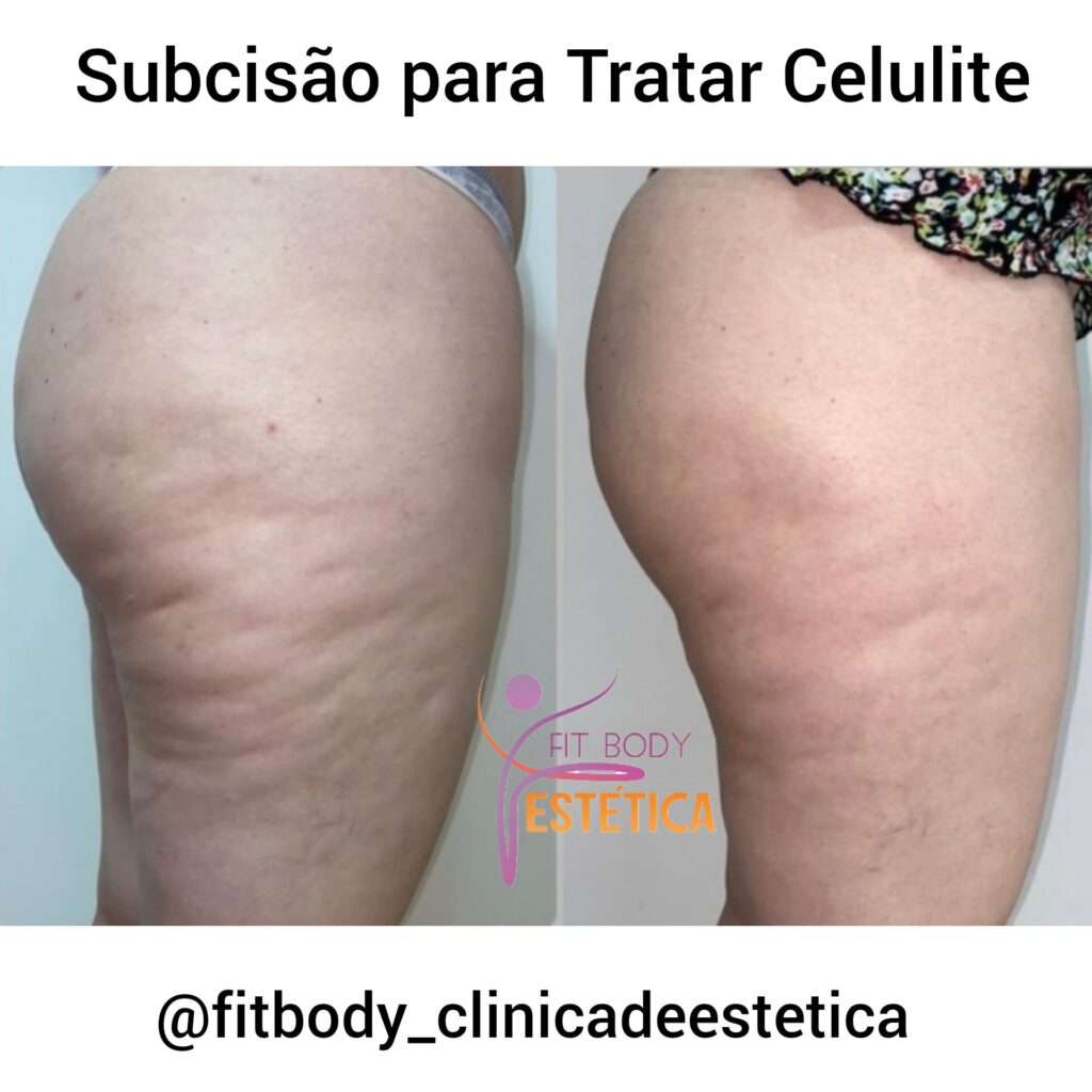 Subcisão para Tratar Celulite