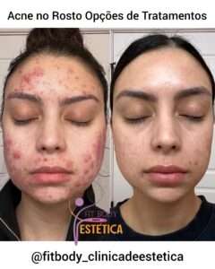 Acne no Rosto Opções de Tratamentos