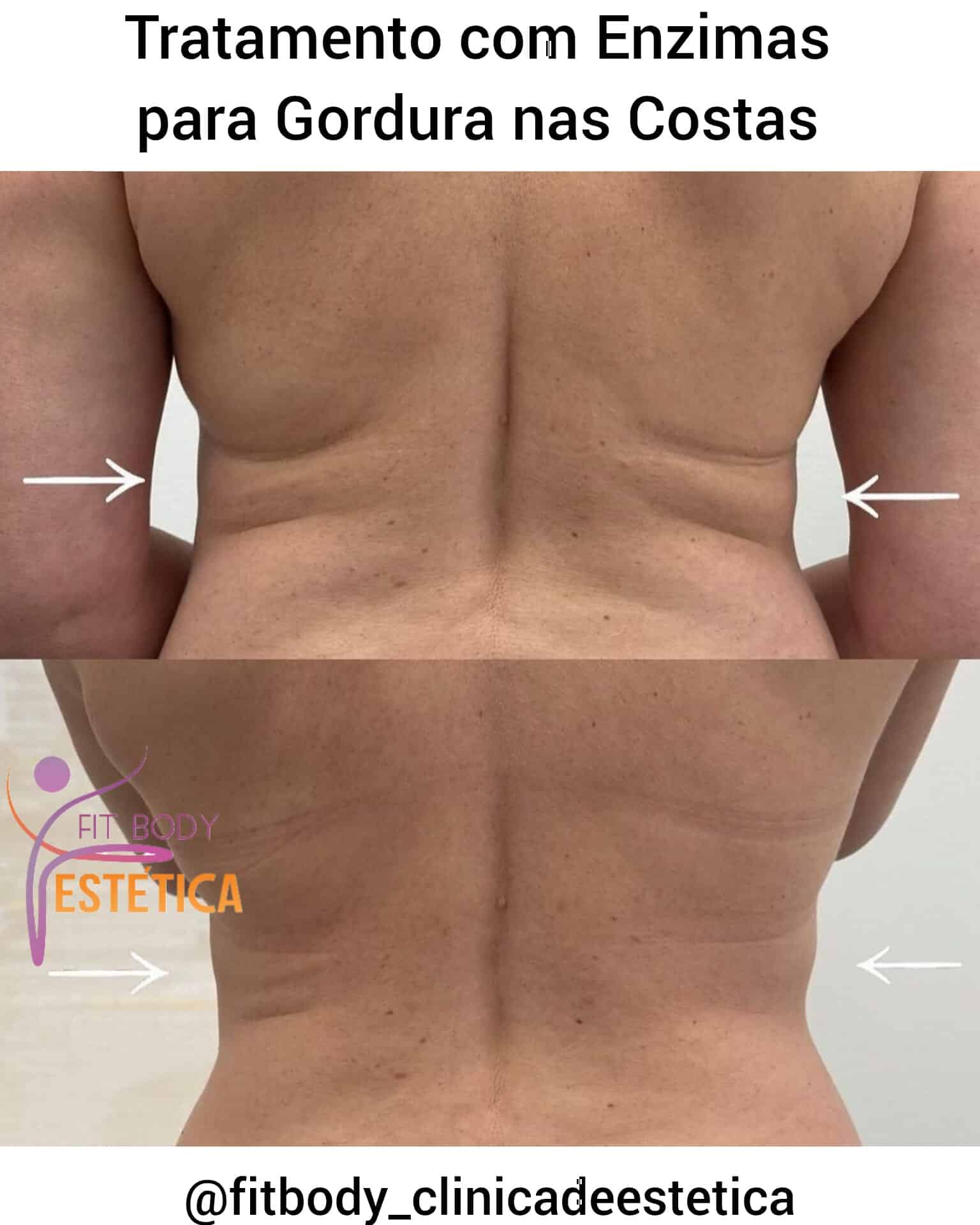 Como perder Gordura nas Costas com Enzimas