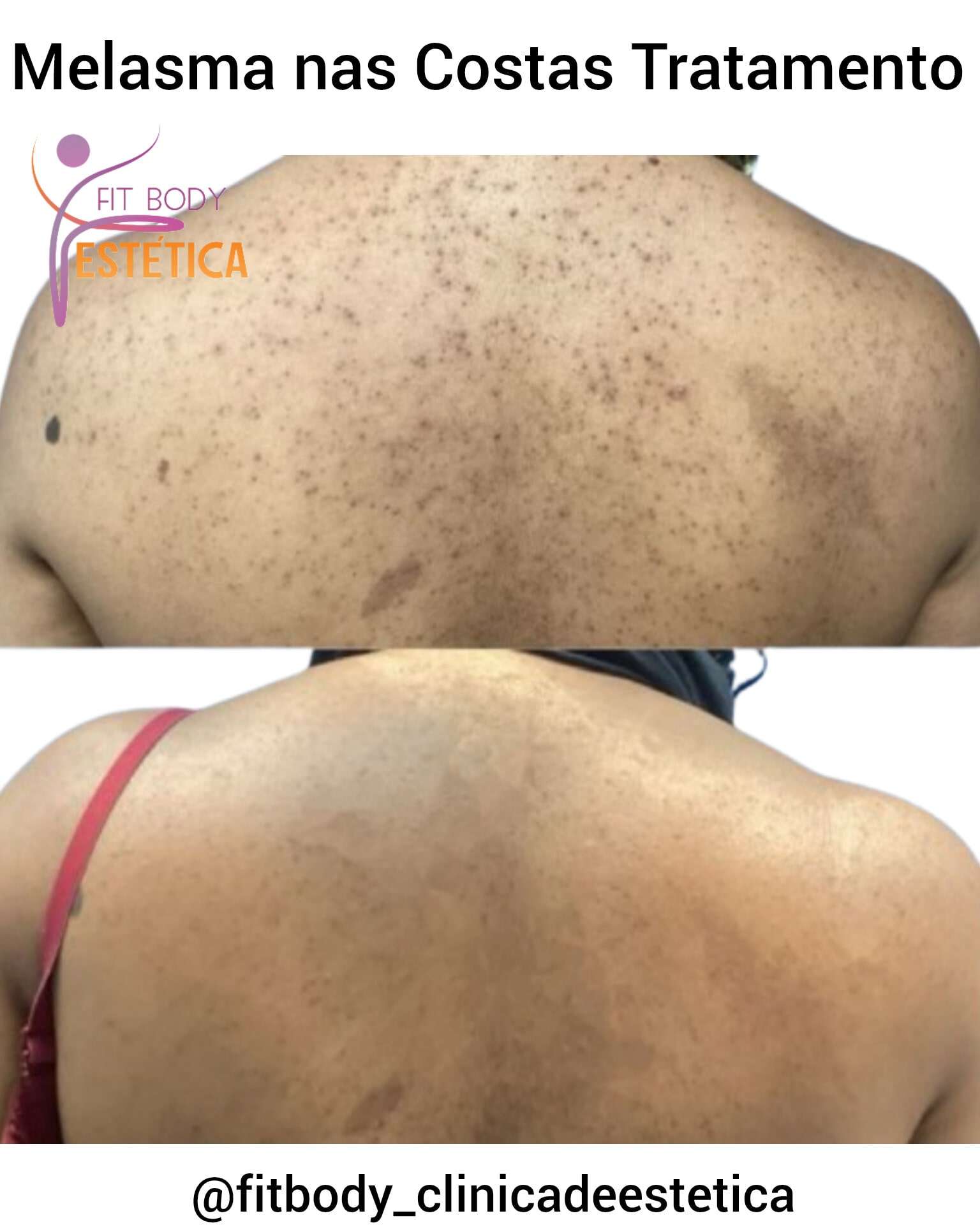 Melasma nas Costas Tratamento