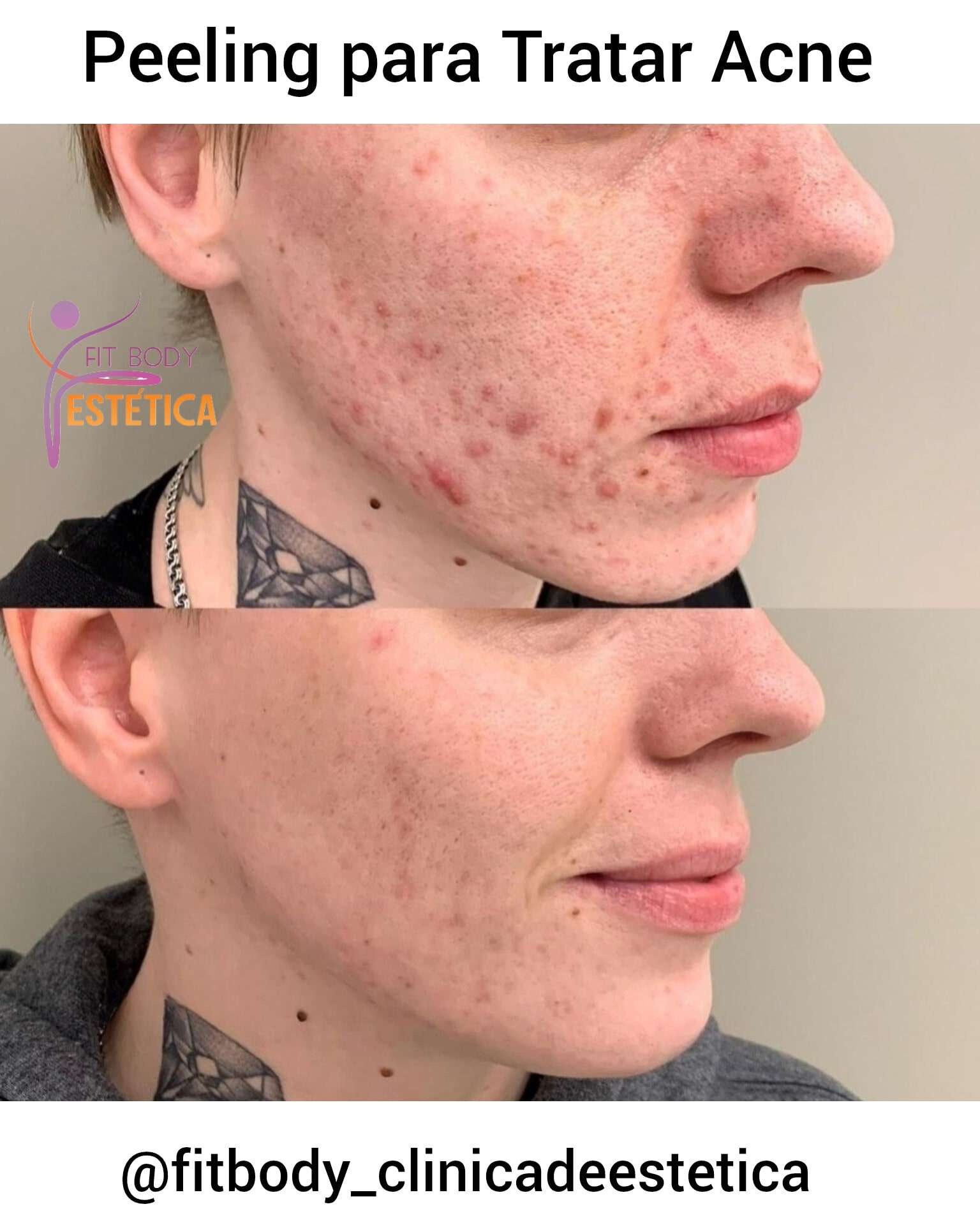 Peeling Químico para Acne