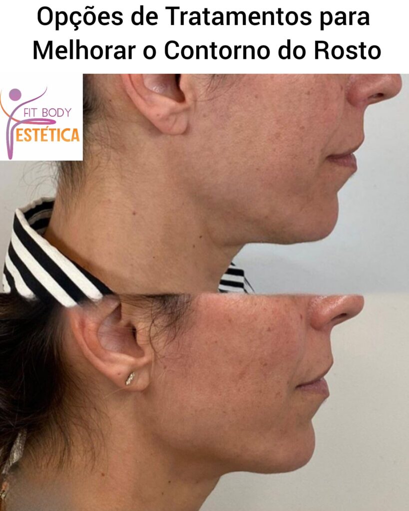 Qual o melhor procedimento para melhorar o contorno do rosto