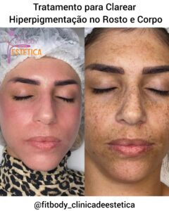 Tratamento para Clarear Hiperpigmentação no Rosto e Corpo