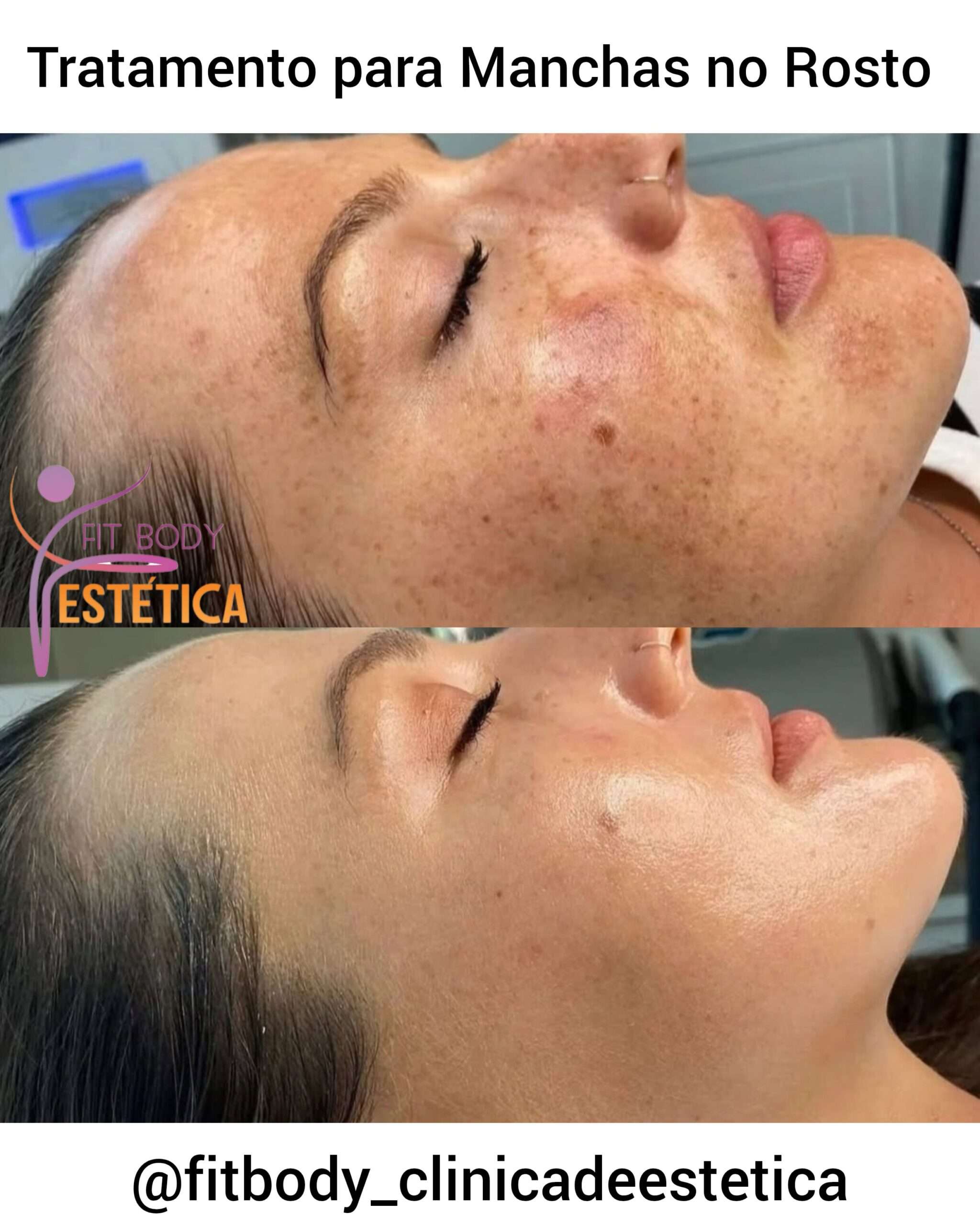 Tratamento para Manchas no Rosto Antes e Depois