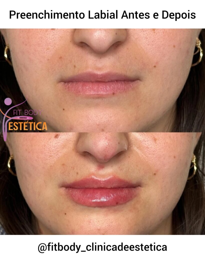 Preenchimento Labial 1 ml Antes e Depois