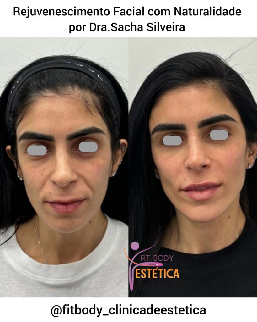 Rejuvenescimento Facial Natural