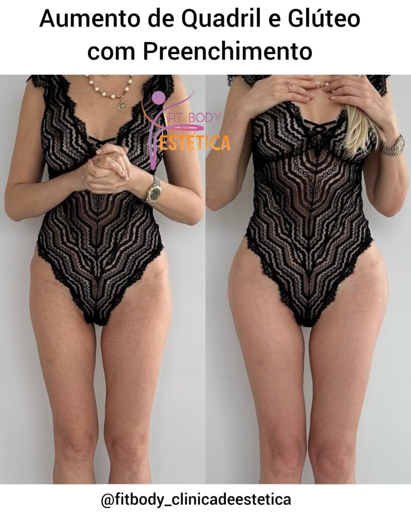 Saiba Como Aumentar Quadril e Glúteo