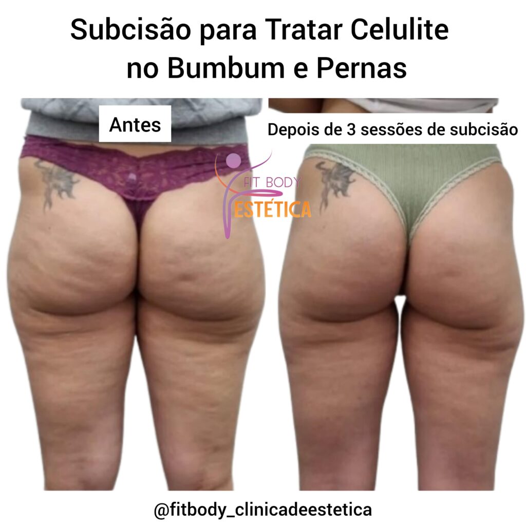 Subcisão para Tratar Celulite no Bumbum e Pernas