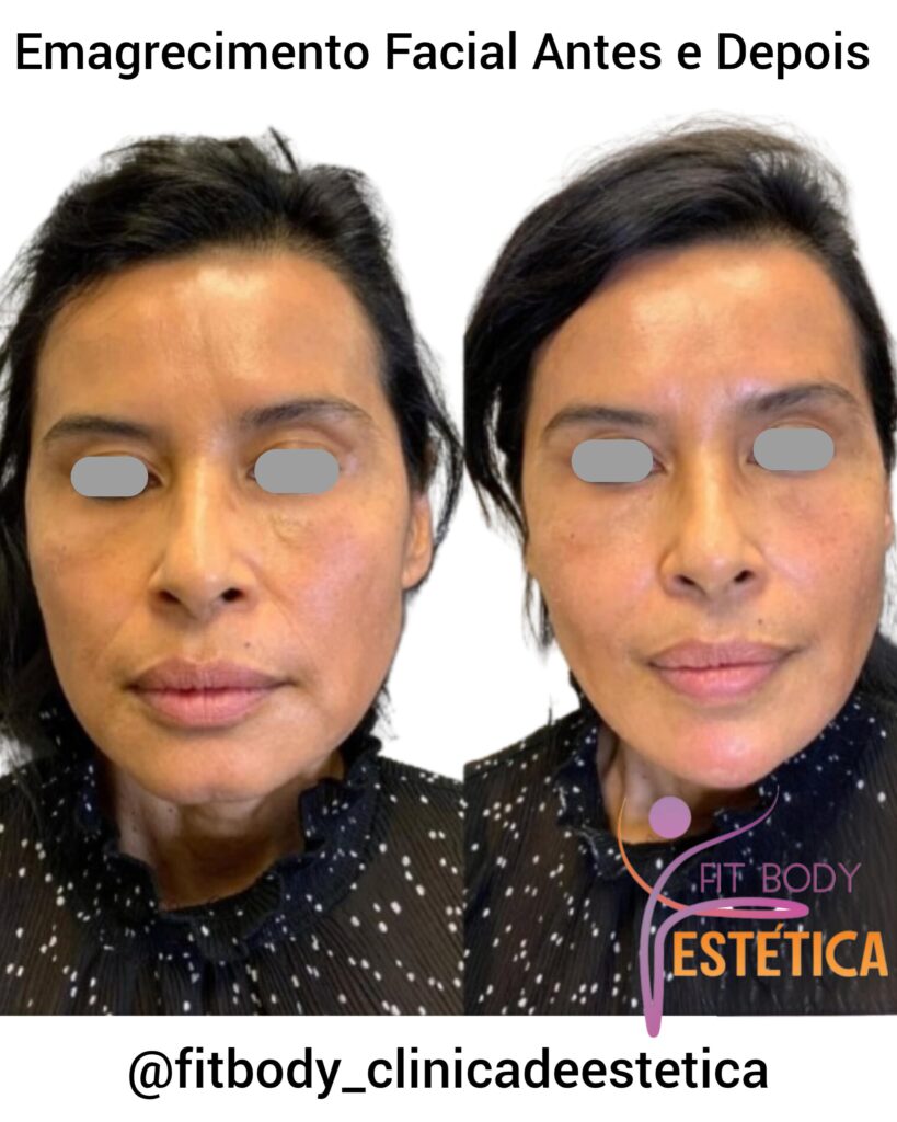 Emagrecimento Facial