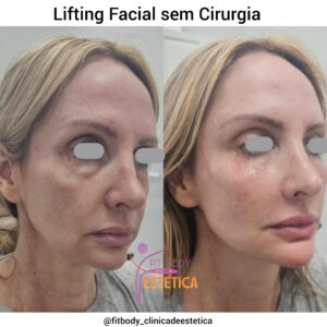 Lifting Facial Antes e Depois