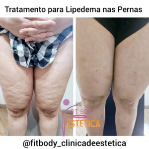 Lipedema nas Pernas Tratamento