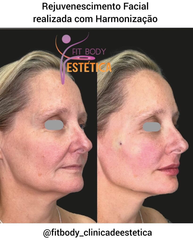 Rejuvenescimento Facial feita com Harmonização