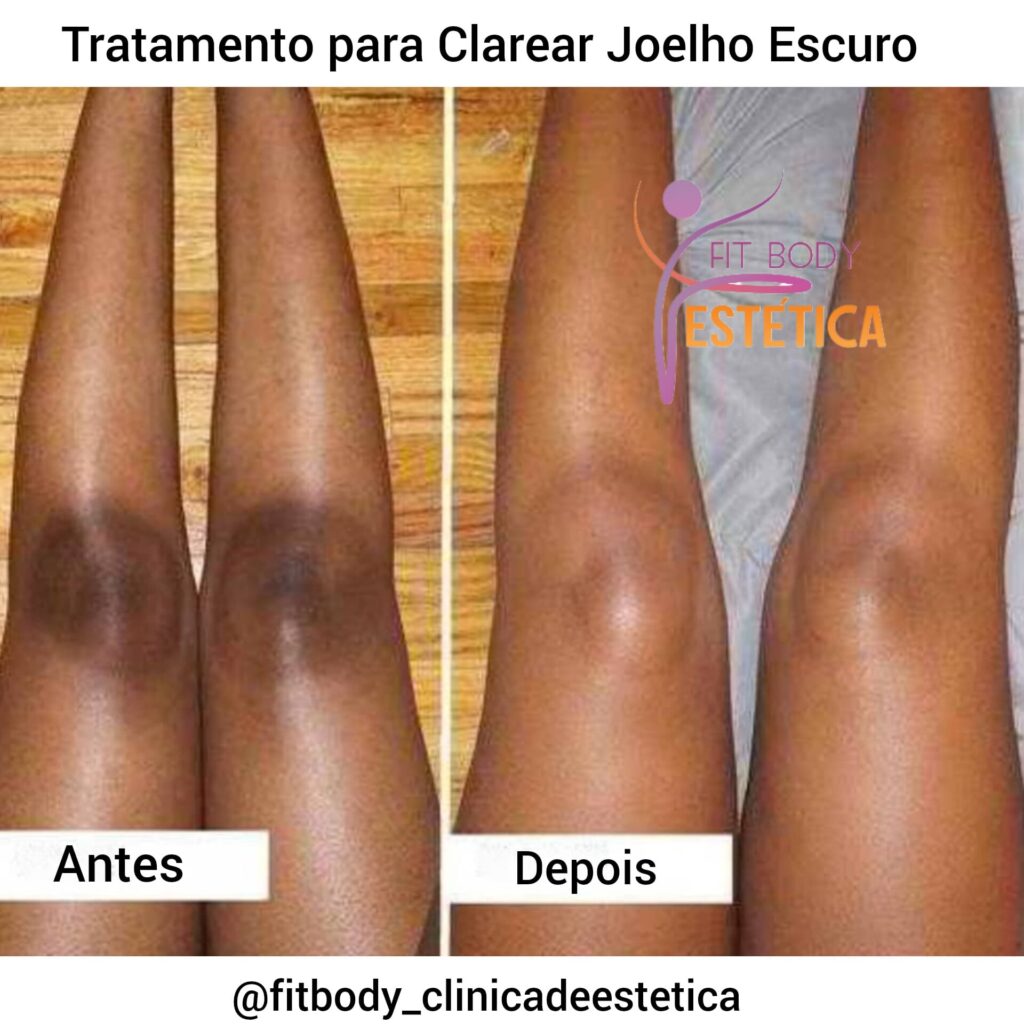 Tratamento para Clarear Joelho Escuro