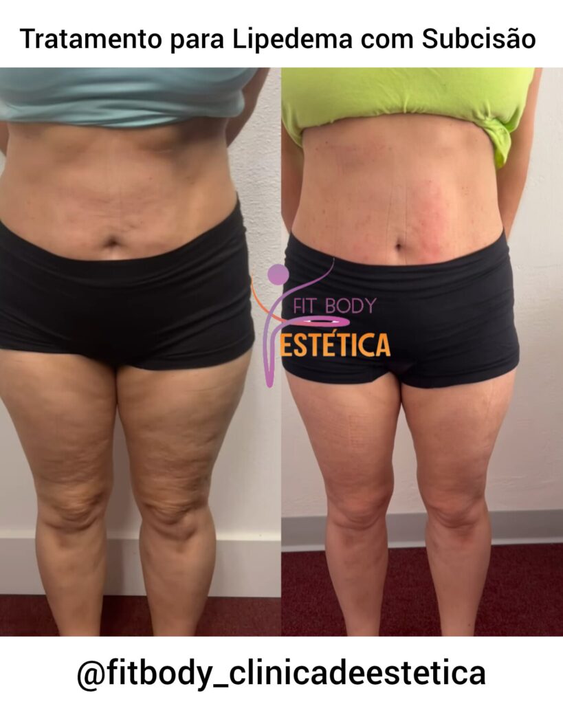 Tratamento para Lipedema com Subcisão