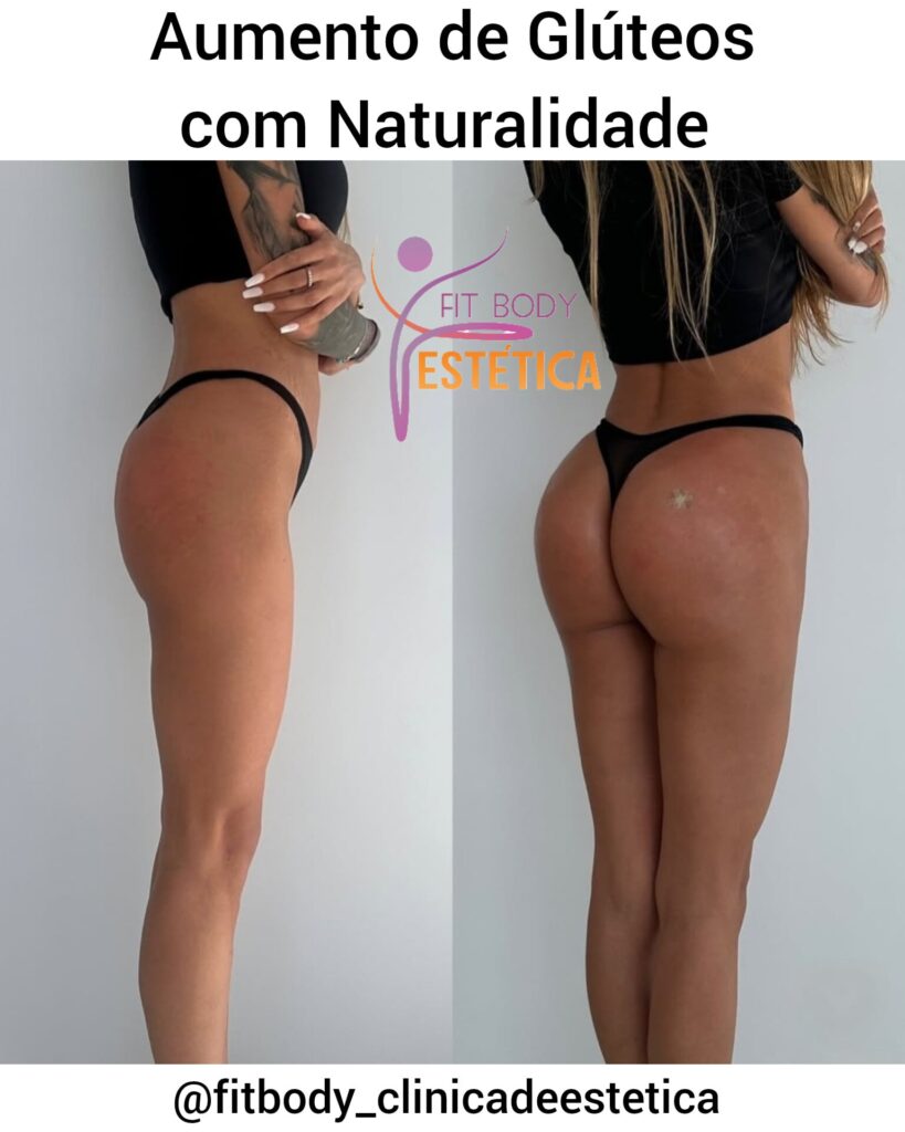 Aumento de Glúteo Valor do Procedimento