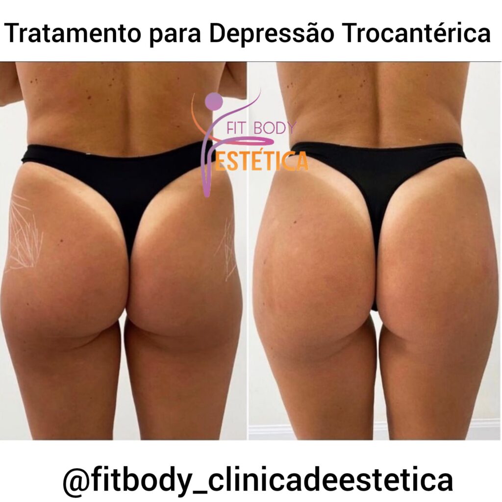 Depressão Trocantérica Preço do Tratamento