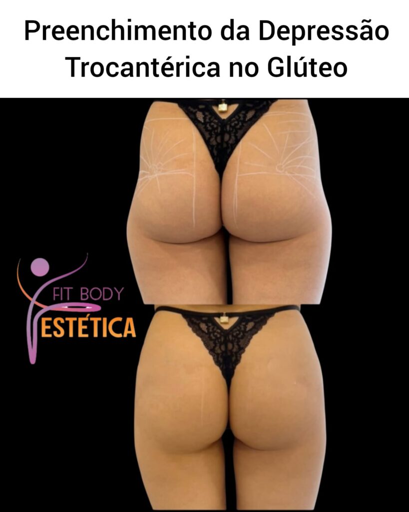 Depressão Trocantérica no Glúteo