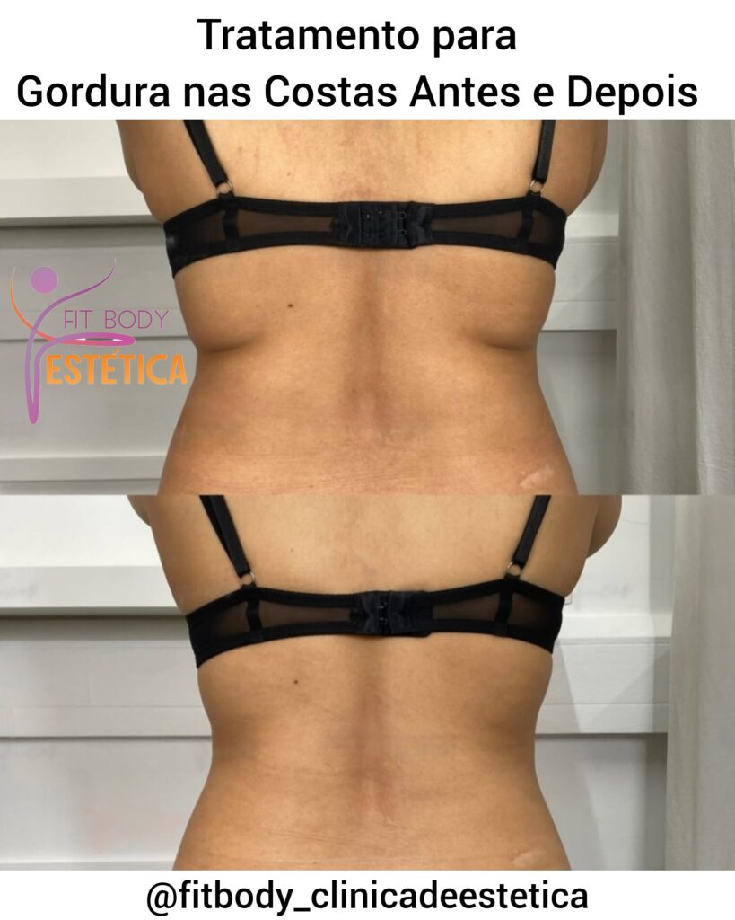 Gordura nas Costas Antes e Depois