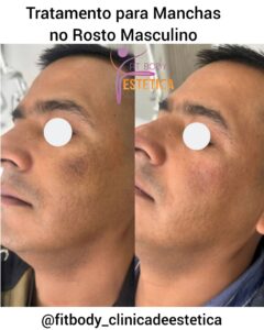 Manchas no Rosto Masculino