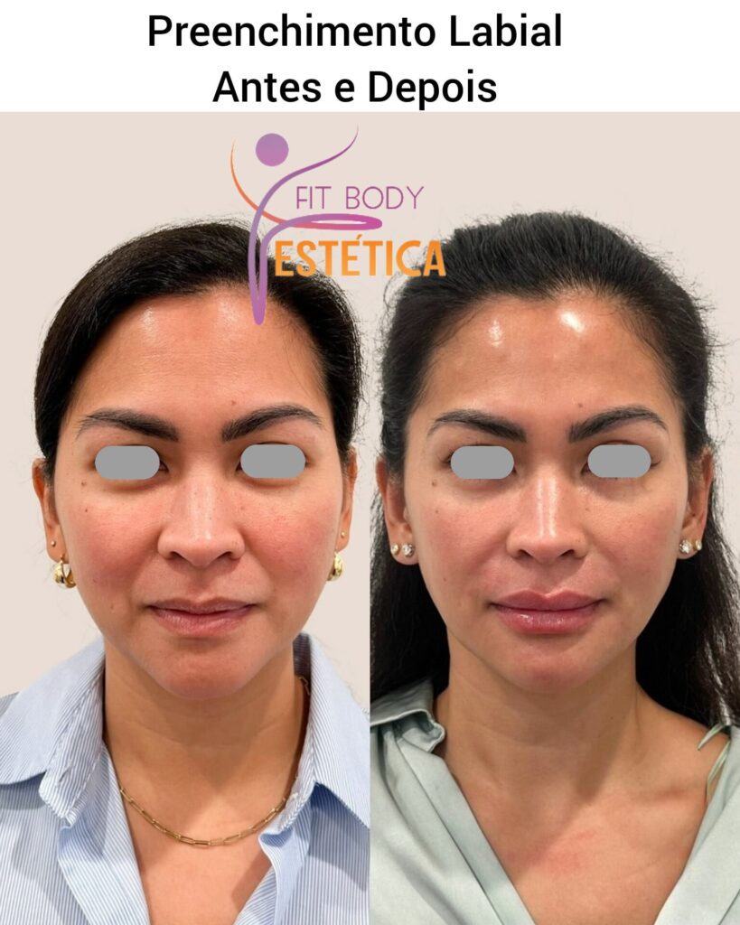 Preenchimento Labial 2 ml Antes e Depois