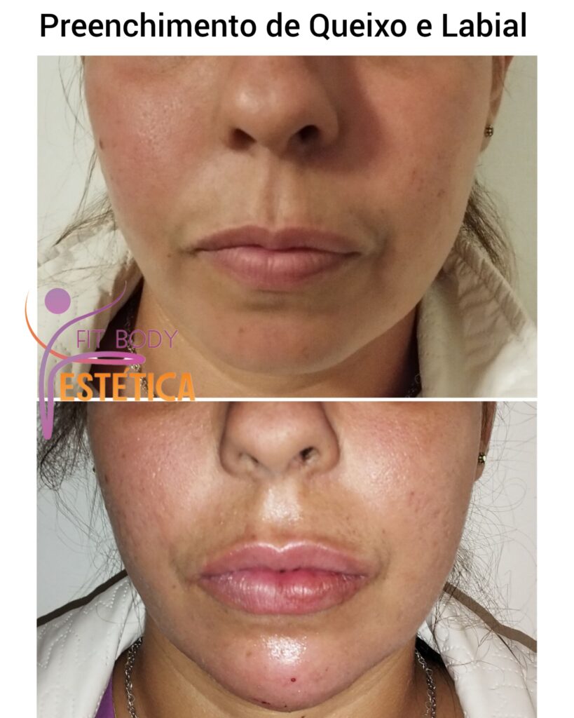 Preenchimento de Queixo e Labial Antes e Depois