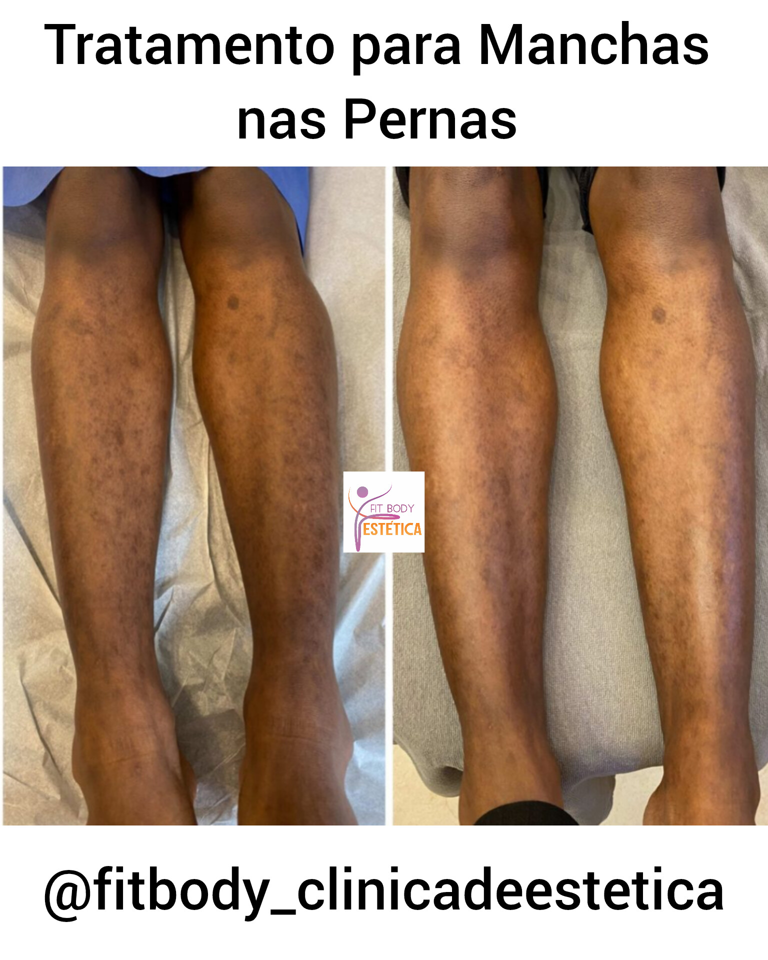 Saiba como Tratar as Manchas nas Pernas