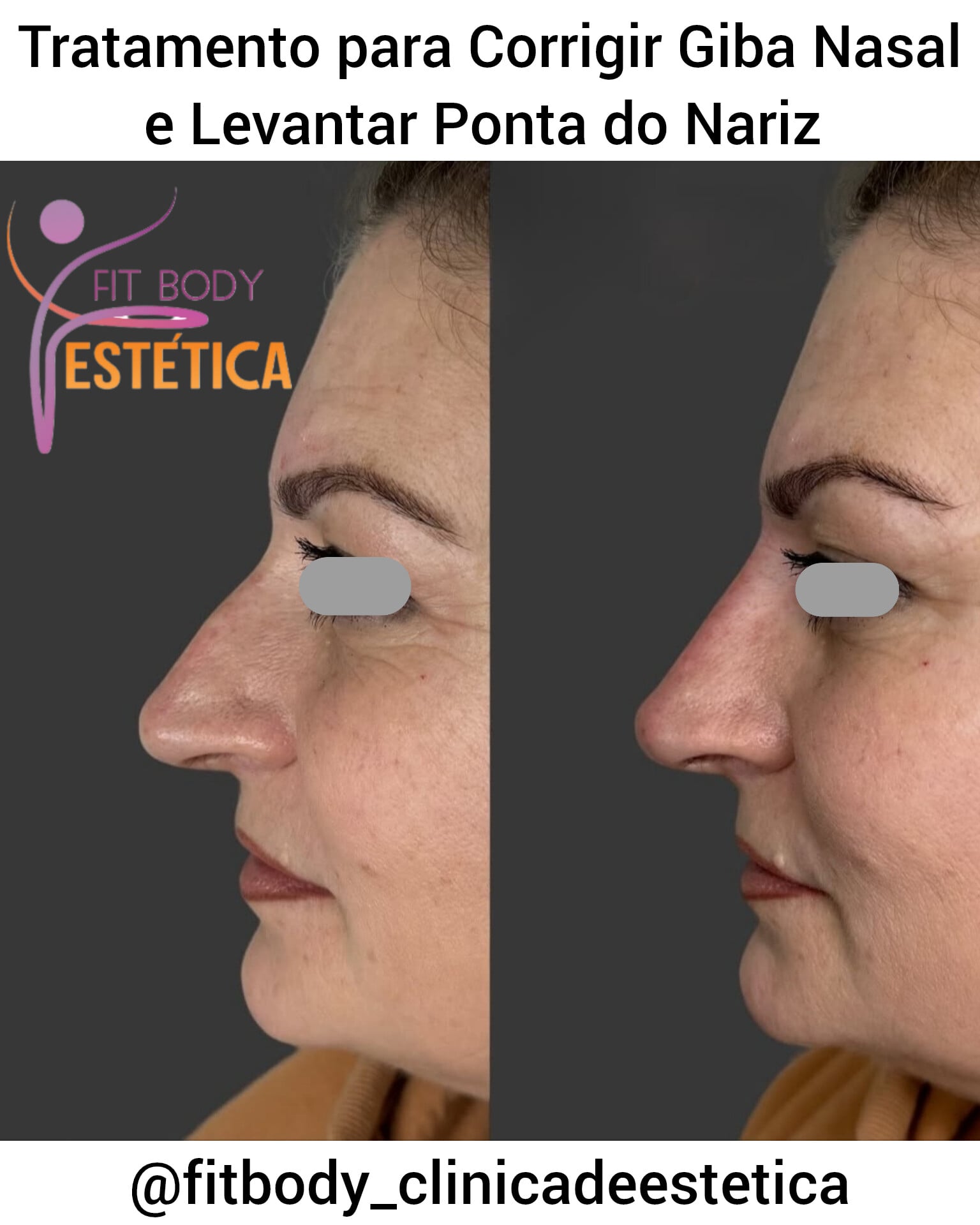 Tratamento para Levantar Ponta do Nariz