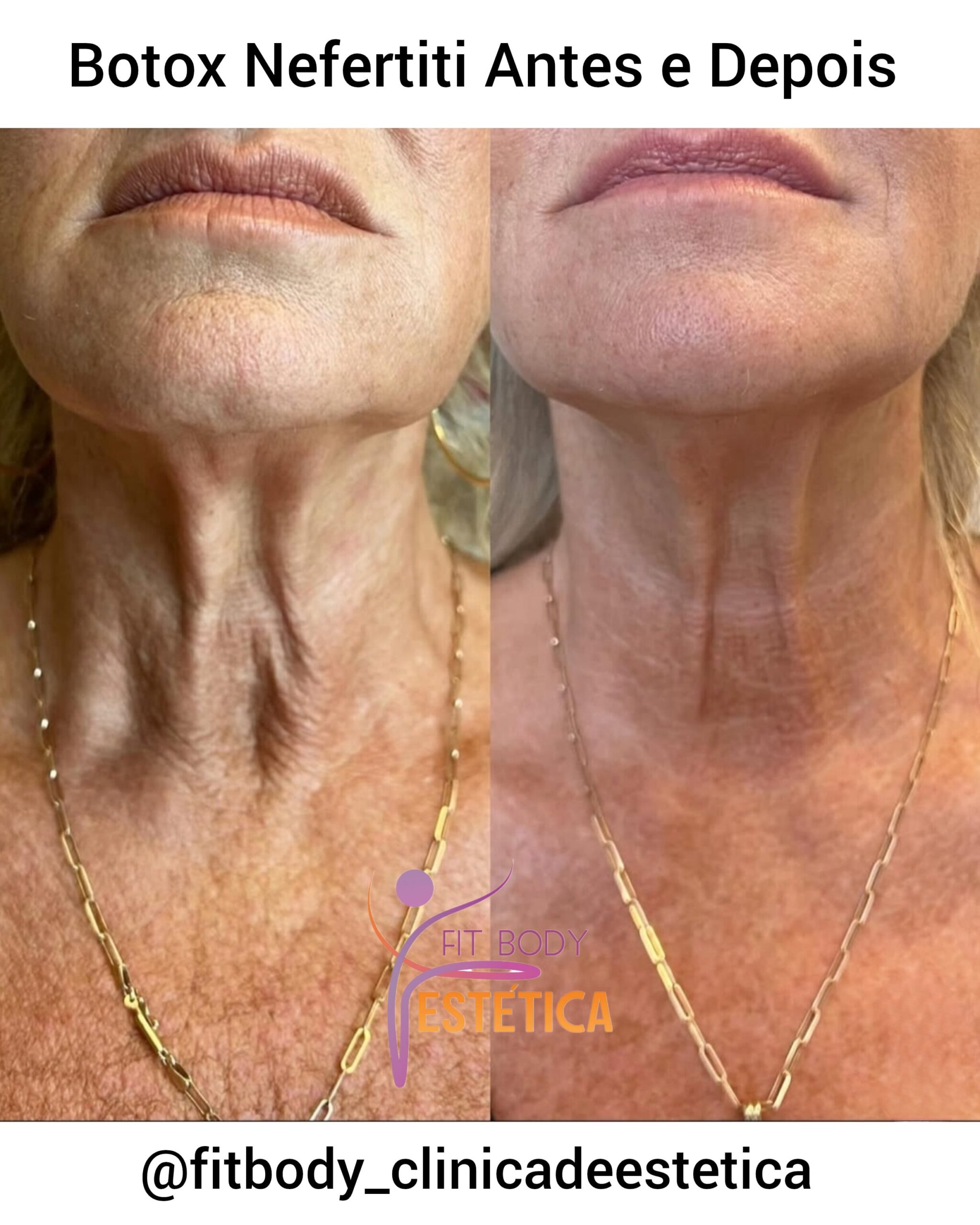 Botox Nefertiti Antes e Depois