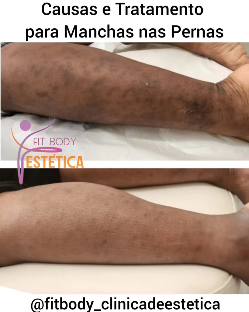 Causas e Tratamento para Manchas nas Pernas