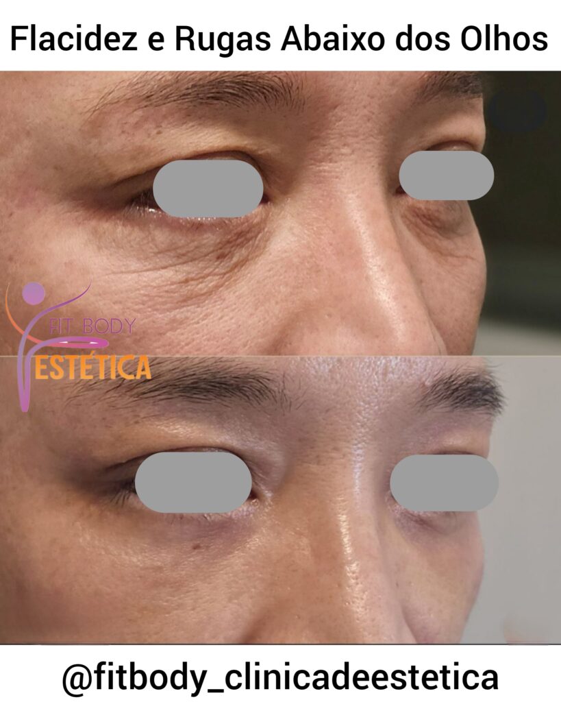 Flacidez e Rugas Abaixo dos Olhos