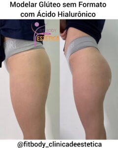 Modelar Glúteo sem Formato com Ácido Hialurônico
