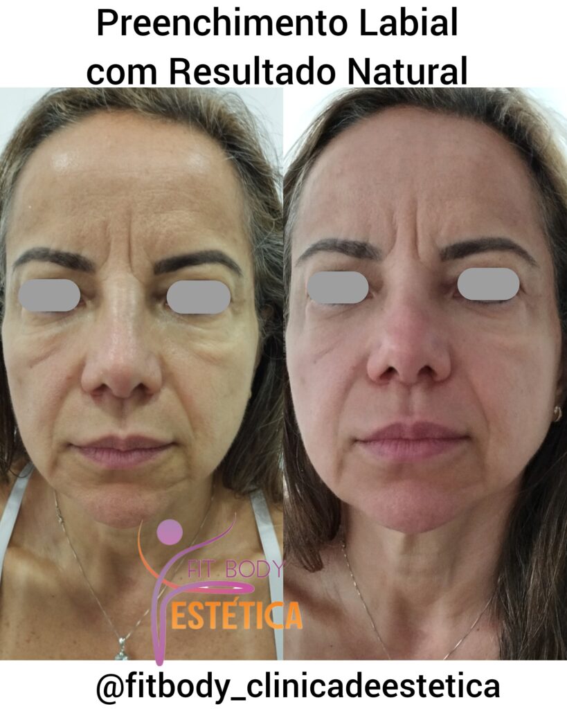 Preenchimento Labial com Resultado Natural
