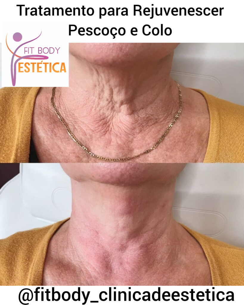 Rejuvenescer Pescoço e Colo