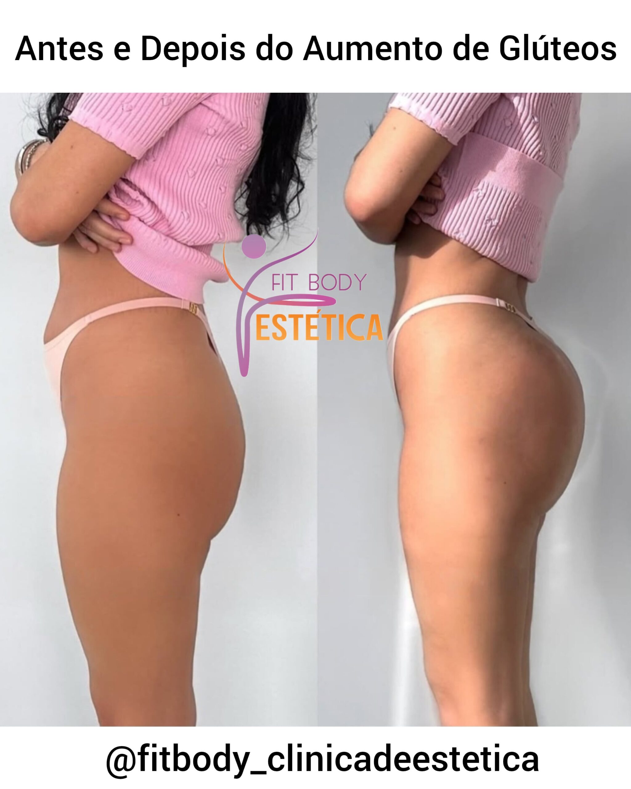 Antes e Depois do Aumento de Glúteos
