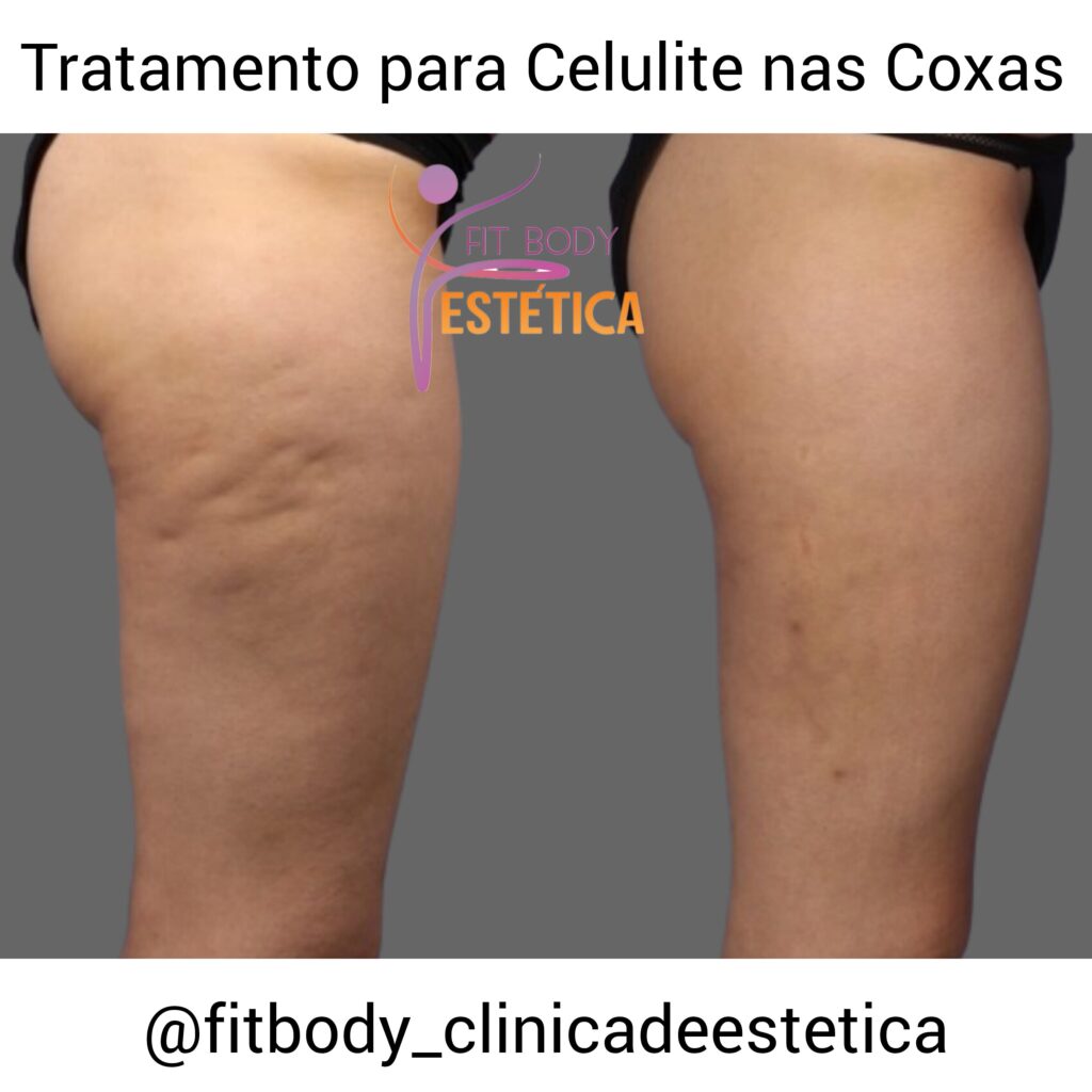Celulite nas Coxas Antes e Depois