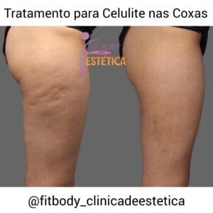 Celulite nas Coxas Antes e Depois