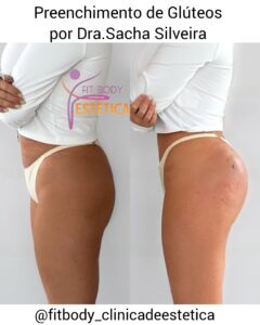 Como é Realizado Preenchimento de Glúteos