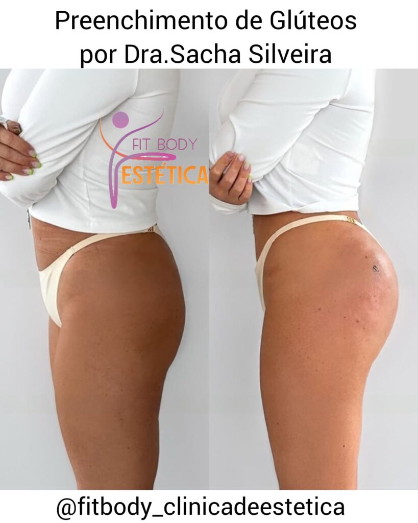 Como é Realizado Preenchimento de Glúteos